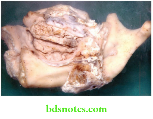 Specimens Specimen OF hemiglossectomy with Hemimandibulectomy