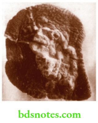 Specimens Squamous Cell Carcinoma