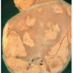 Specimens Tuberculous (TB) Lymphasenitis