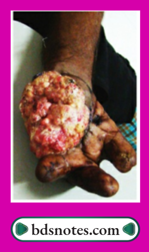Squamous Cell Carcinoma Arising In Leprosy Scar