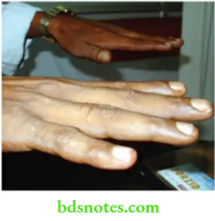 The Thyroid Gland Fine Tremors Of The Hand Is Tested In the Outstrectched hand by keeping a fine paper on the fingers