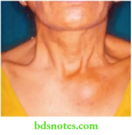 The Thyroid Gland This Lady Presented With Secondary In The Left Second Rib