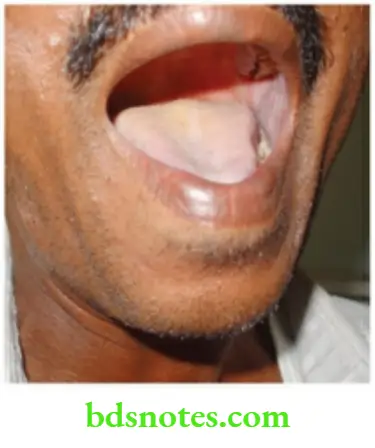 The Thyroid Gland Tounge Tremors Are Checked With Tounge Inside The oral Cavity