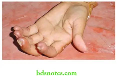 Upper Limb Ischaemia Case of SLE—Observe pulp of the fingers