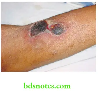 Upper Limb Ischaemia Drug-induced gangrene caused by Ibuprofen