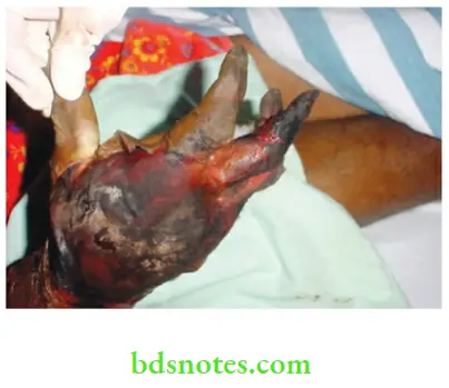 Upper Limb Ischaemia Emboli at the brachial artery resulting in massive gangrene of the hand