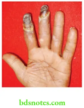Upper Limb Ischaemia Gangrene of middle and index fingers of the left hand due to cervical rib