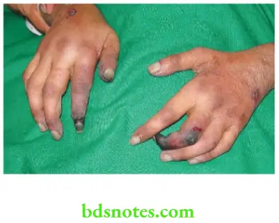 Upper Limb Ischaemia Gangrene of the two fingers in a case of vasculitis syndrome