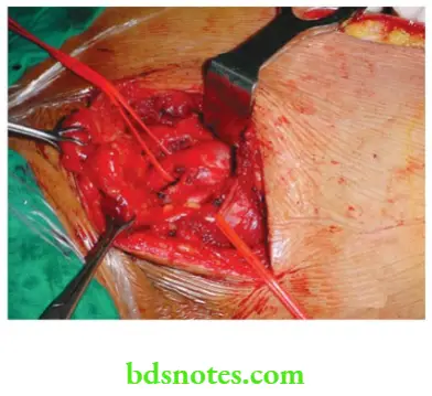 Upper Limb Ischaemia Subclavian artery exposed to repair the dilatation and removal of the thrombus