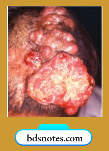Urban Tumor SCC Scalp