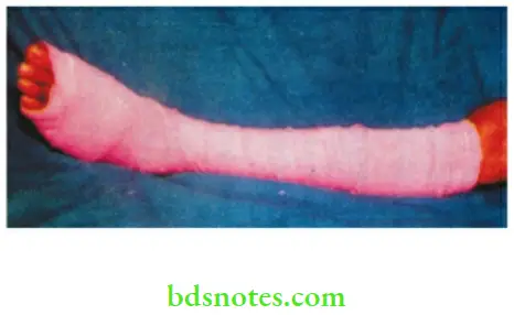 Varicose Veins And Deep Vein Thrombosis Elastic crepe bandage for varicose ulcer— elevation of the leg is the most important factor for healing of the ulcer