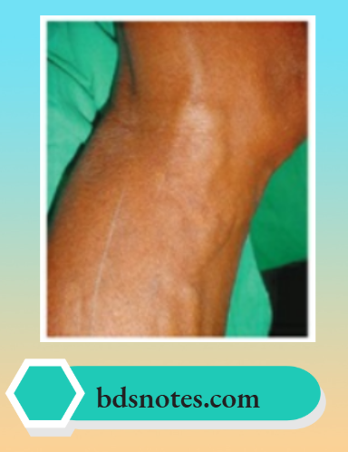 Varicose Veins And Deep Vein Thrombosis Grade 2