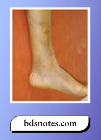 Varicose Veins And Deep Vein Thrombosis Grade 3
