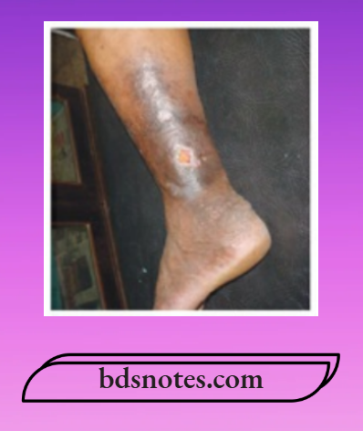 Varicose Veins And Deep Vein Thrombosis Grade 4