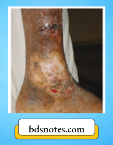 Varicose Veins And Deep Vein Thrombosis Grade 5