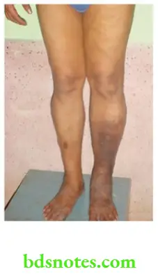 Varicose Veins And Deep Vein Thrombosis Grossly swollen leg, pigmentation, eczema and secondary varicosity in a case of chronic DVT of the leg