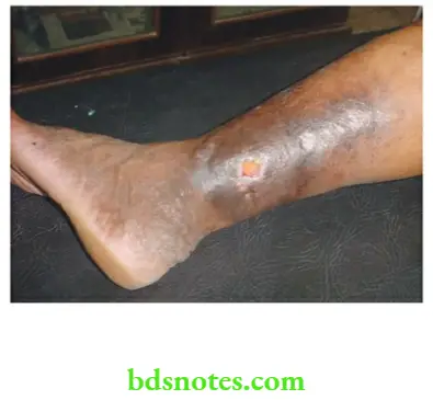 Varicose Veins And Deep Vein Thrombosis Observe pigmentation, lipodermatosclerosis and ulcer formation