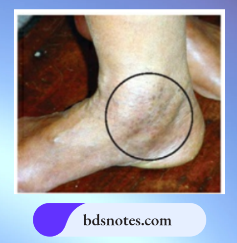Varicose Veins Grade 1
