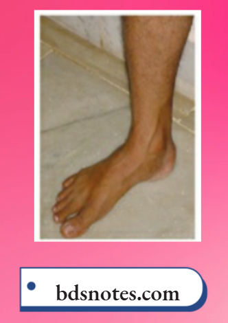 Varicose Veins Grade