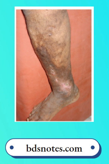 Varicose Veins Lipodermatosclerosis