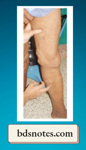 Varicose Veins Schwartz Test