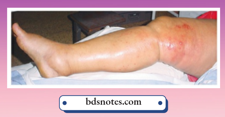 Varicose Veins Swollen Leg Edema Blisters