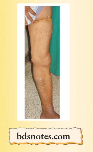 Varicose Veins Trendelenburg II Slow Filling