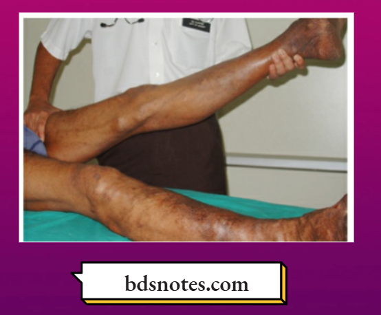 Varicose Veins Trendelenburg Test Part 1f