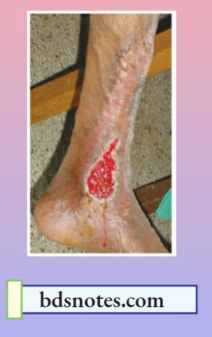 Varicose Veins Venous Ulcer