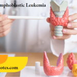 Acute Lymphoblastic Leukemia.