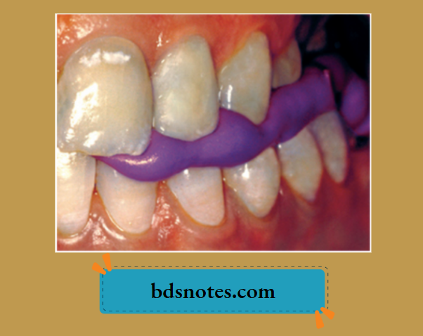 Bite registration procedure using bite registration silicone