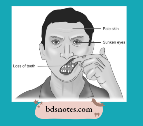 Cachexia Clinical Features