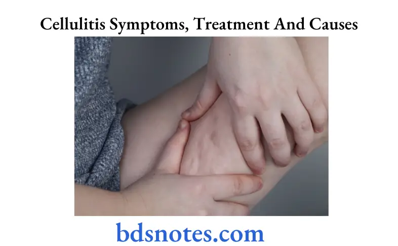 Cellulitis Symptoms, Treatment And Causes