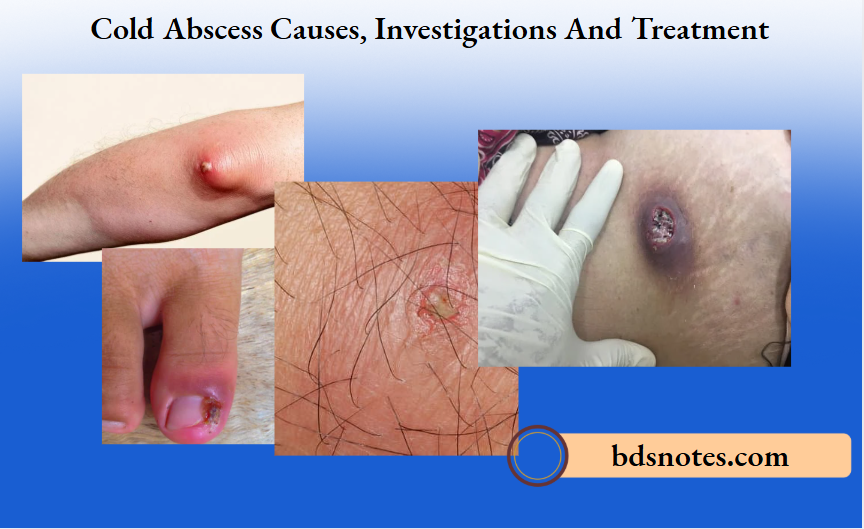Cold Abscess Causes, Investigations And Treatment