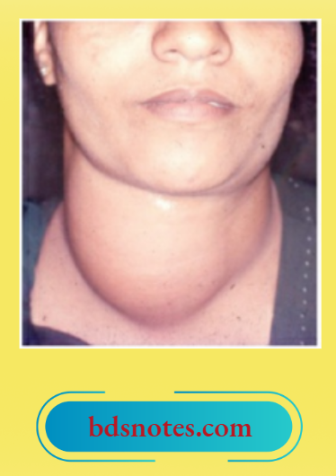 Colloid Goitre Smooth Surface And Round Borders