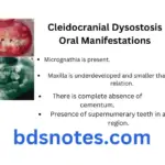 Developmental Disorders of Teeth And Jaw Question And answers Cleidocranial Dysostosis Oral Manifestations