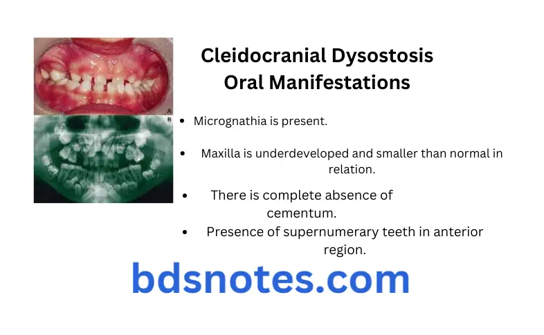 Developmental Disorders of Teeth And Jaw Question And answers Cleidocranial Dysostosis Oral Manifestations