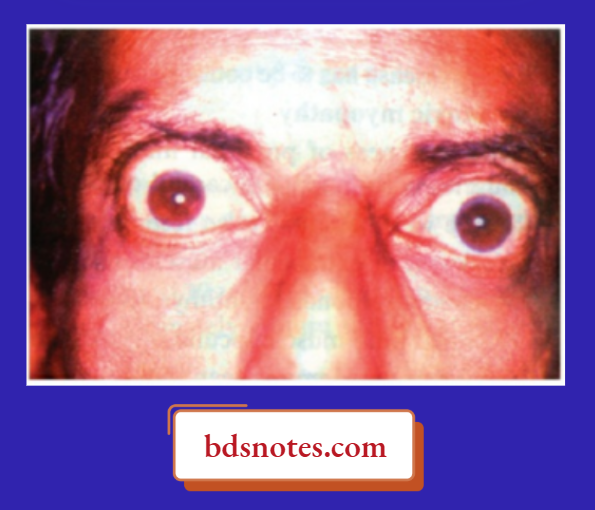 Exophthalmos—Classical Of Primary Thyrotoxicosis