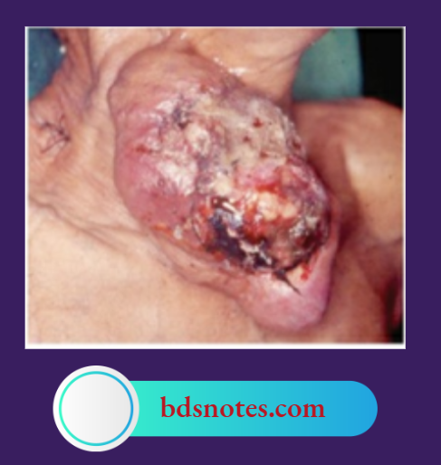 Papillary Carcinoma