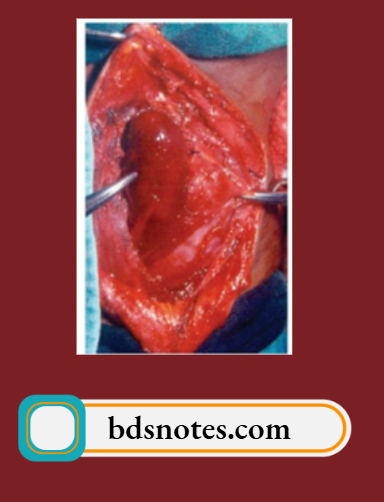 Parathyroid, Adrenals And Pituitary Glands Superior Parathyroid Found Near The Upper Pole Of The Thyroid Gland