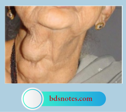This Lady Underwent Hemithyroidectomy Two Years Back. Now Recurrance In The Opposite Lobe