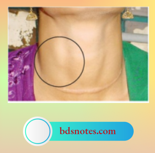 This Lady Underwent Subtotal Thyroidectomy For MNG. After One year She Presented With A Solitary Lymph Node