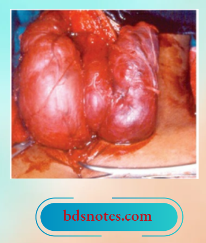 Thyroid Gland Same Patient As In At Surgery