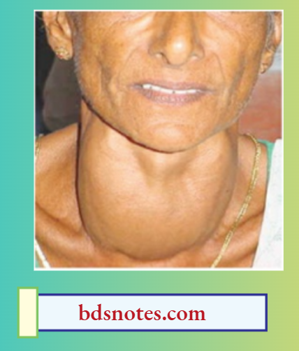 Toxic Multinodular Goitrenodular Surface And Vascular