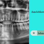 Ameloblastoma Notes