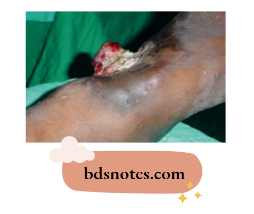 Angiosarcoma vs Hemangioma Comparison
