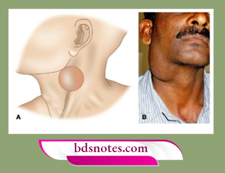 Branchial Cyst Illustration And Clinical Presentation
