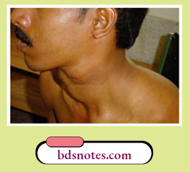 Branchial Cyst In The Neck