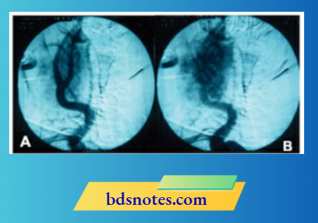 Carotid Angiography Observe Separation Of Internal And External Carotid Artery By The Tumour And Vascular Blush