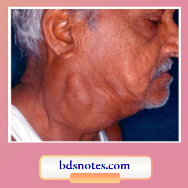 Carotid Body Tumour Classical Site